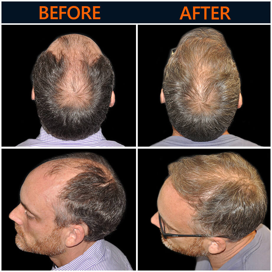Hair Restoration Before & After