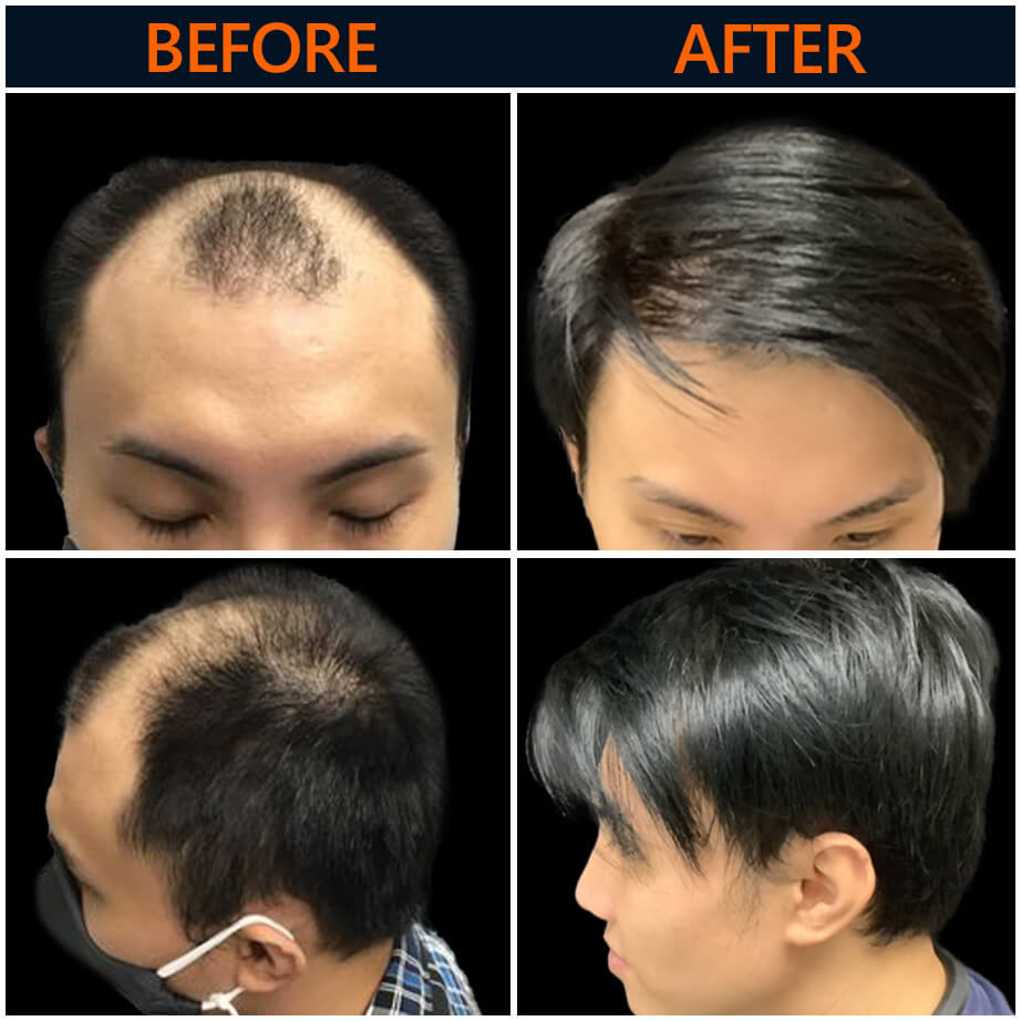 Hair Restoration Before And After