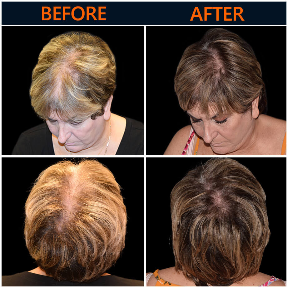 Hair Restoration Results