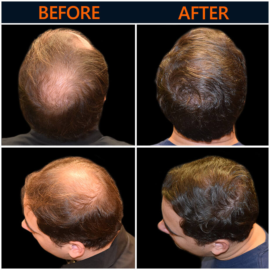 Before & After Hair Restoration