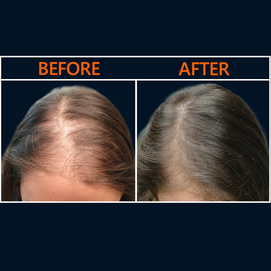Before And After Hair Restoration