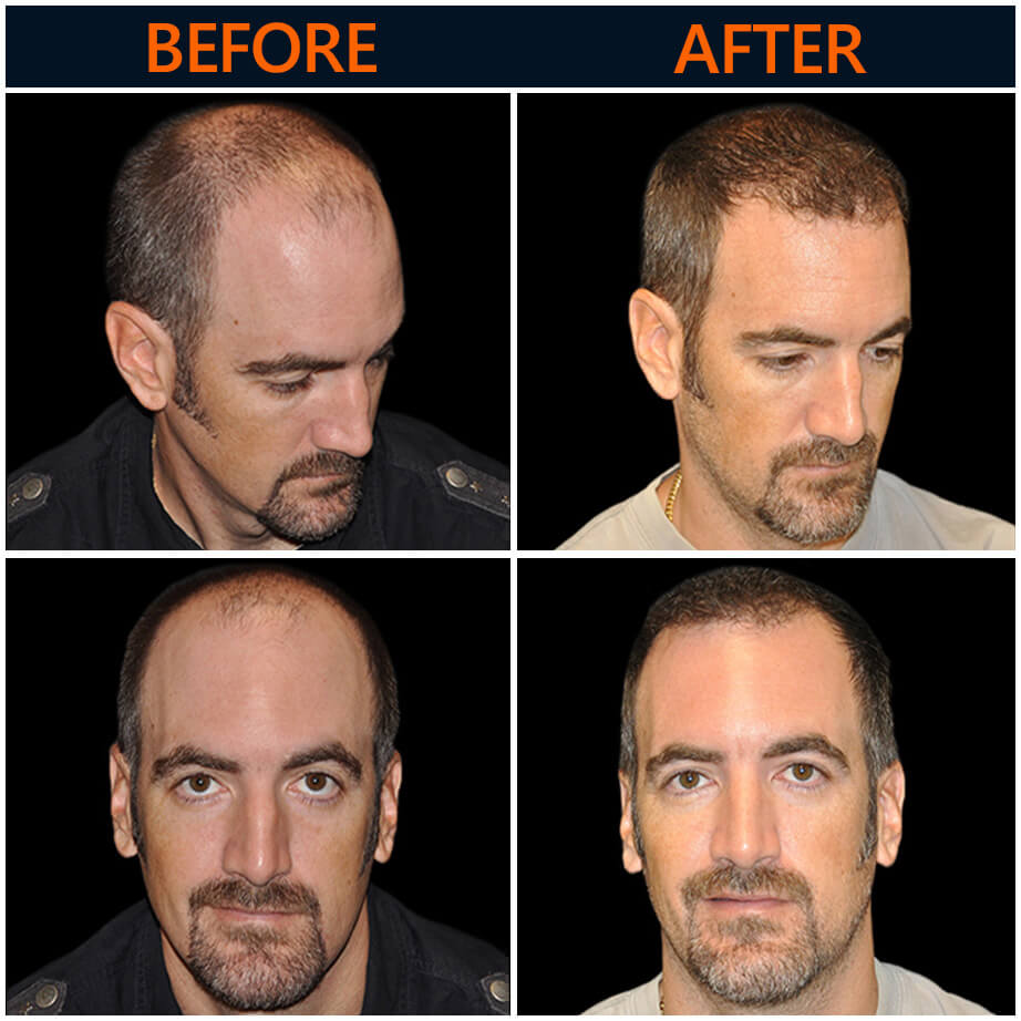 Hair Restoration Procedure Before & After