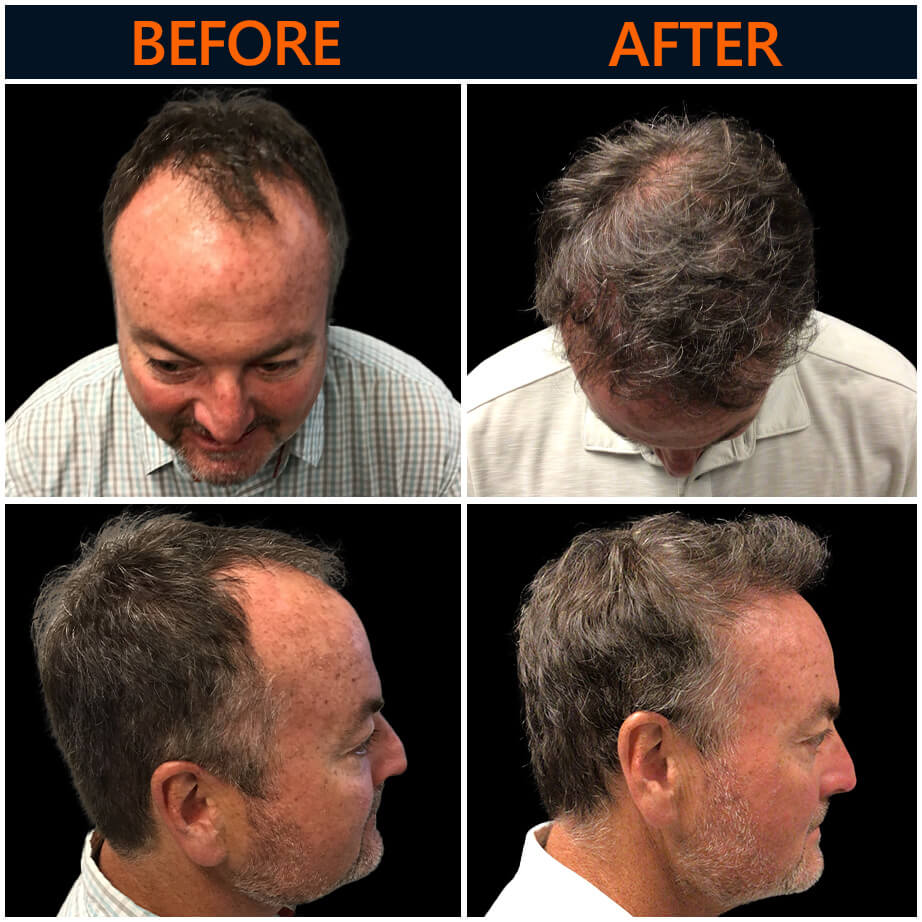 Neograft Before & After