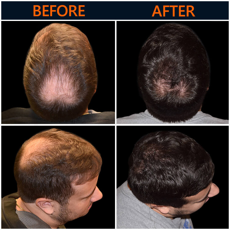 Neograft Before And After