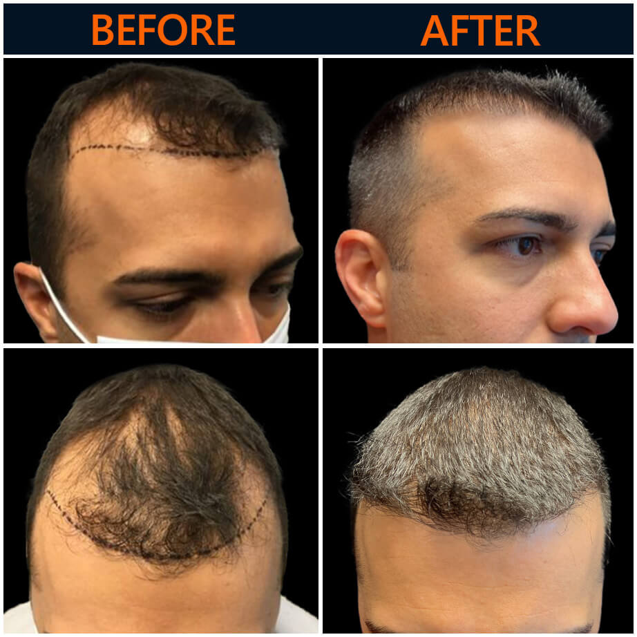 Before & After Neograft