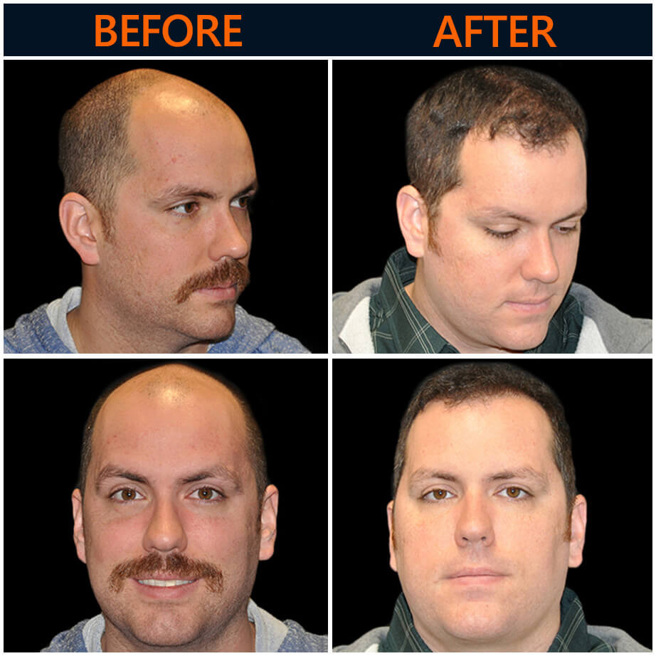 Before And After Neograft