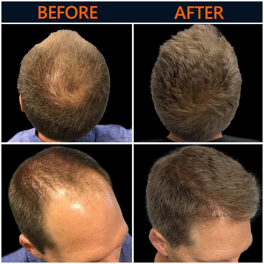 Neograft Procedure Before & After