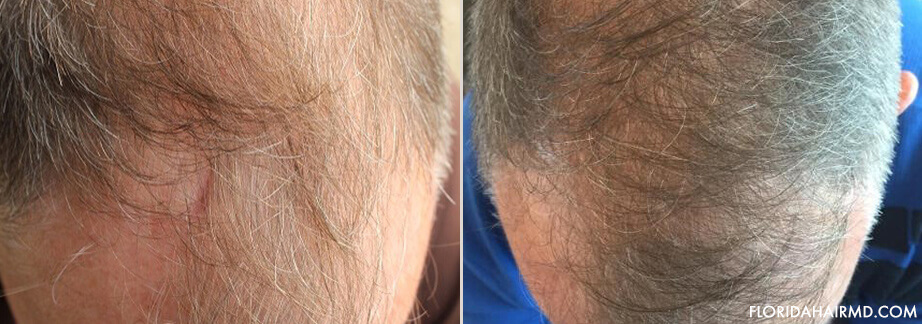 Before & After Stem Cell Hair Restoration