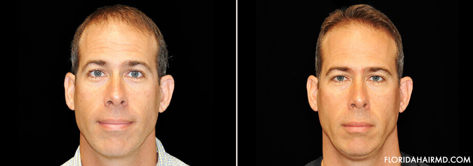 Before And After Hair Restoration