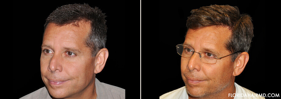 Hair Restoration Treatment Before And After