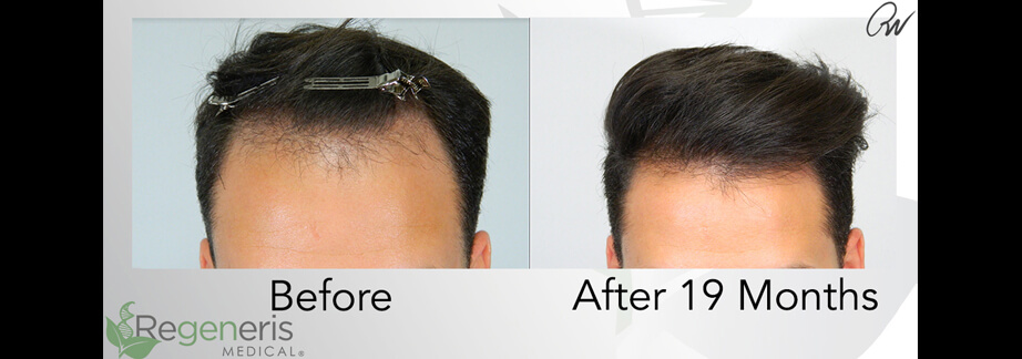 Stem Cell Hair Restoration Treatment Results