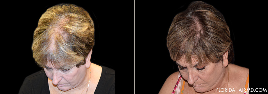 Stem Cell Hair Restoration Before And After