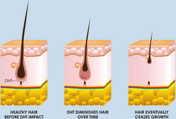 DHT & Hair Loss