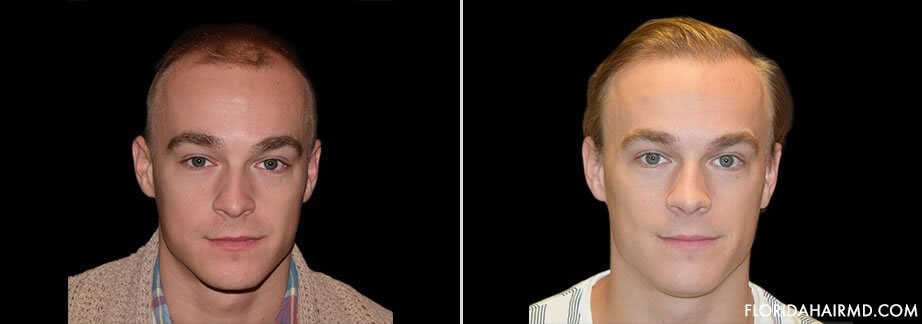 Before & After Hair Restoration