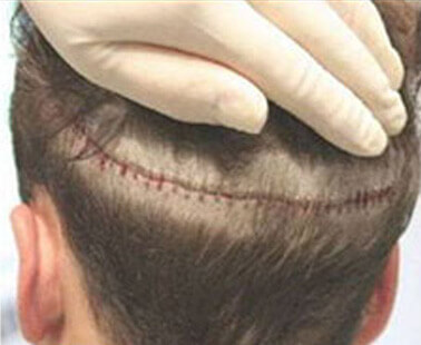 Linear Strip Incision